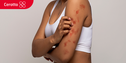Una donna si gratta il braccio a causa di una reazione allergica. Il testo "Cerotto" è scritto in una casella. Una donna si gratta il braccio a causa di una reazione allergica. Il testo "Cerotto" è scritto in una casella.